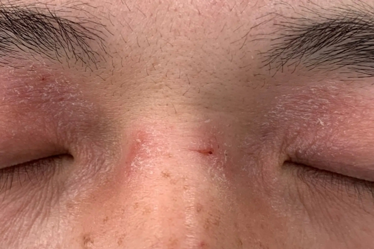 上眼皮特应性皮炎图 上眼皮特应性皮炎图