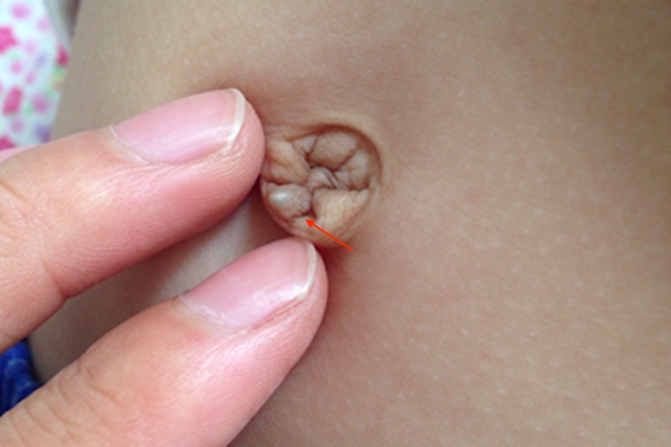 肚脐皮脂腺囊肿图