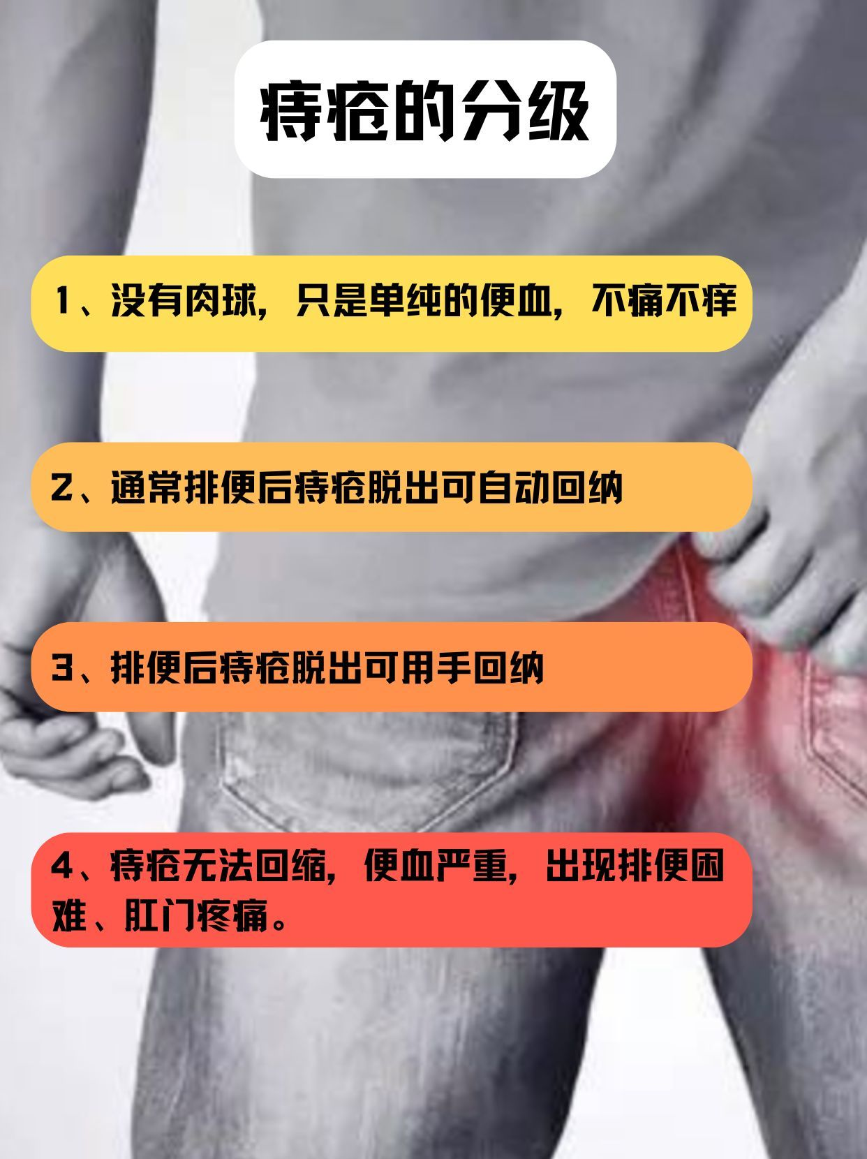 痔疮等级自测｜你的痔疮在哪一级？