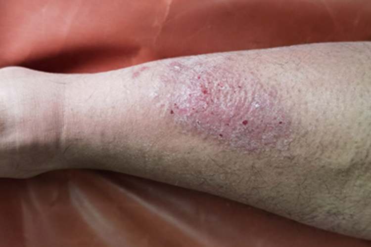 慢性湿疹小腿血点图