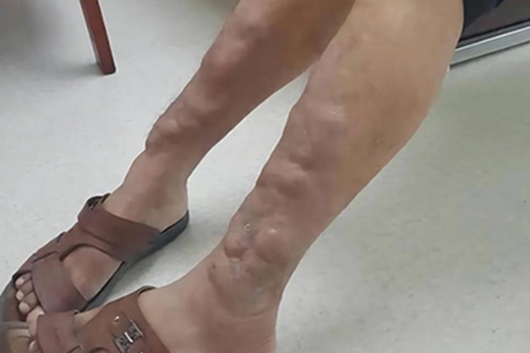 胫前黏液性水肿小腿症状图