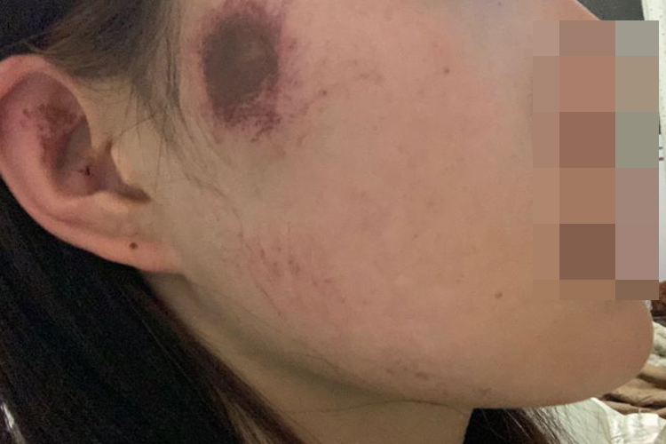 面部擦伤结痂图