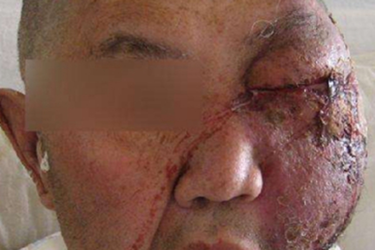 蜂窝织炎脸颊红肿坏死图