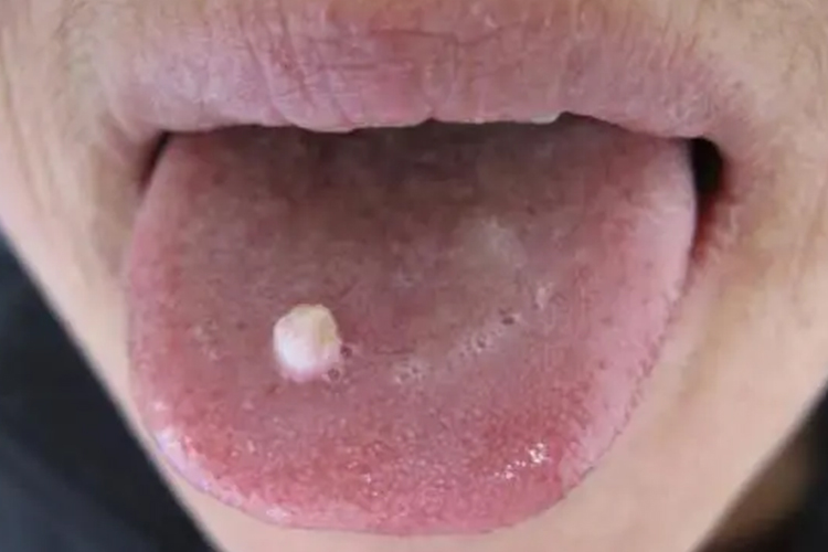淋病导致的舌头白色肉芽图