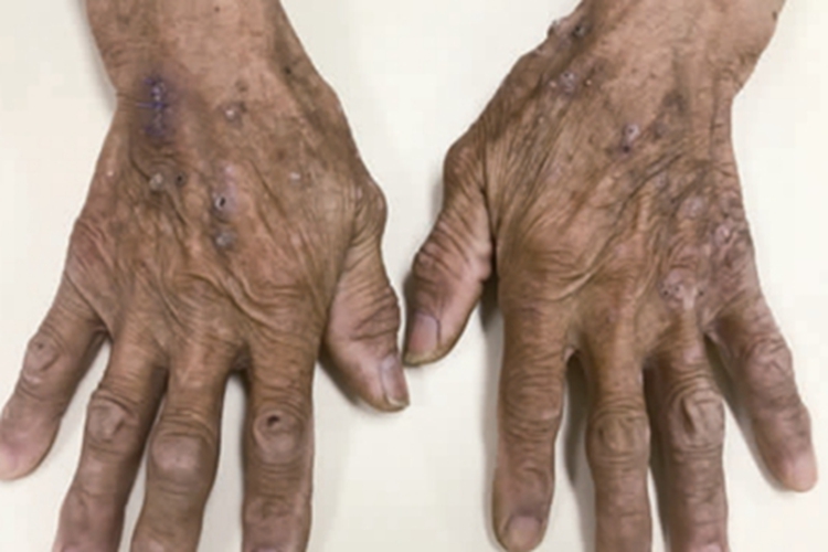 恶性黑棘皮病症状图