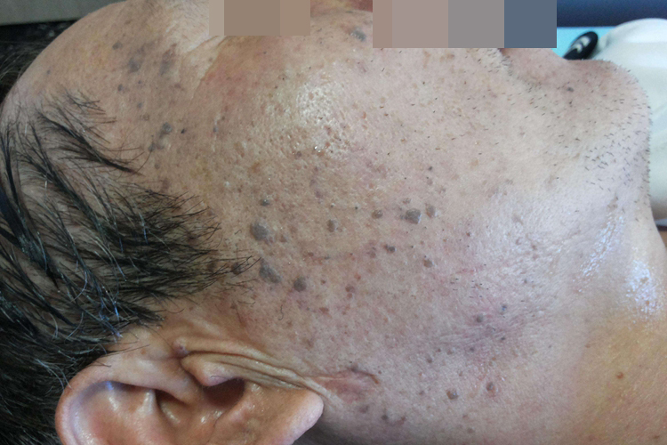 脂溢性角化病脸上黑斑图