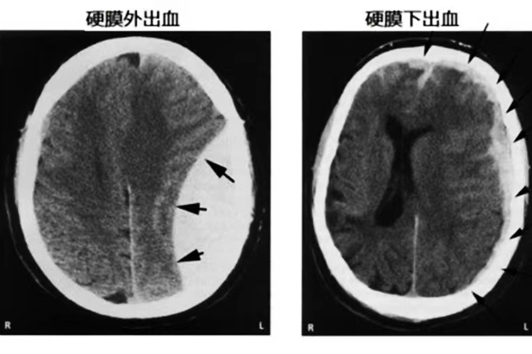 硬脑膜外血肿与硬脑膜下血肿X线图 硬脑膜外血肿与硬脑膜下血肿X线图