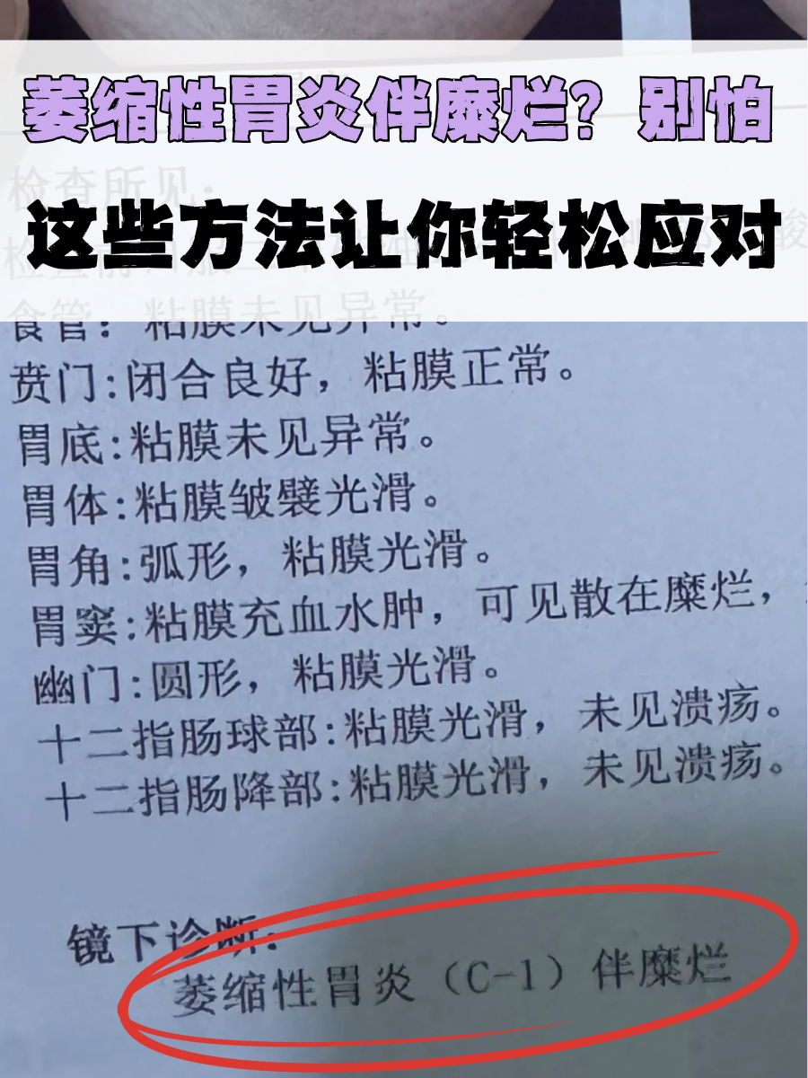 萎缩性胃炎伴糜烂?别怕,这些方法让你轻松应对