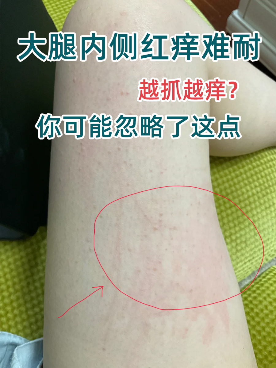 大腿内侧红痒难耐、越抓越痒?你可能忽略了这点