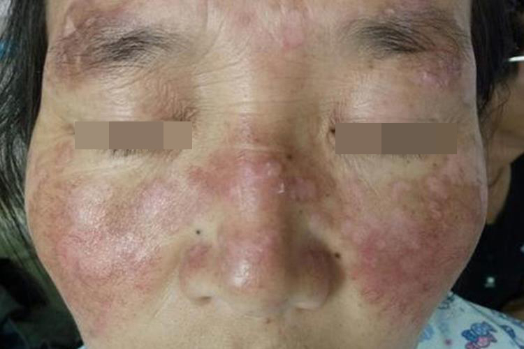 脸部深在性红斑狼疮早期图 脸部深在性红斑狼疮早期图