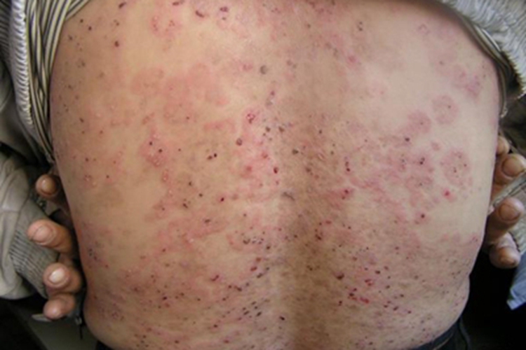 疱疹样皮炎背部症状图 疱疹样皮炎背部症状图