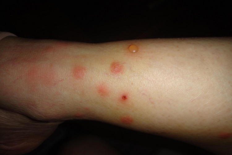 毛虫皮炎小腿水疱图