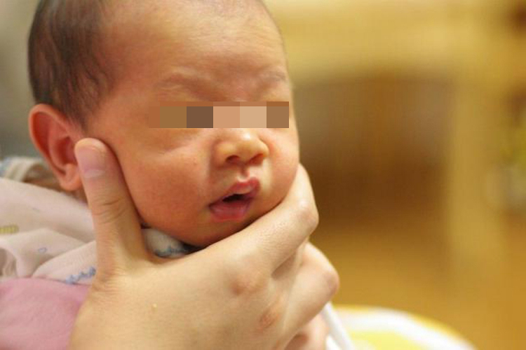 新生儿黄疸脸部图 新生儿黄疸脸部图