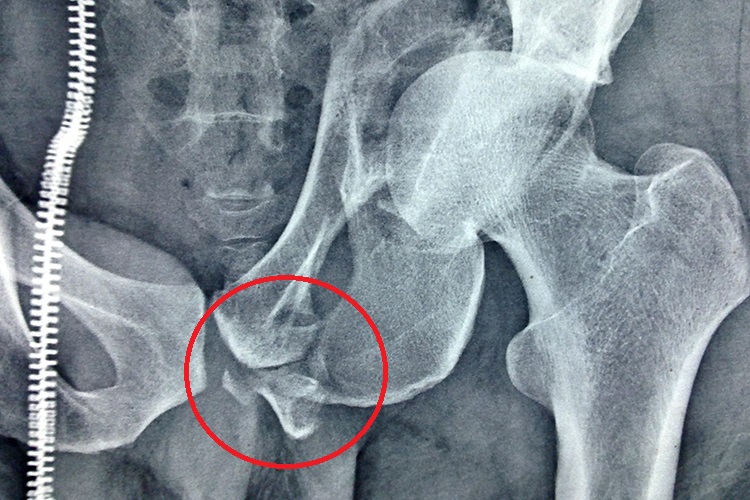 左侧耻骨骨折X线图