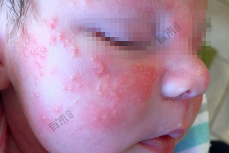 疱疹性湿疹图