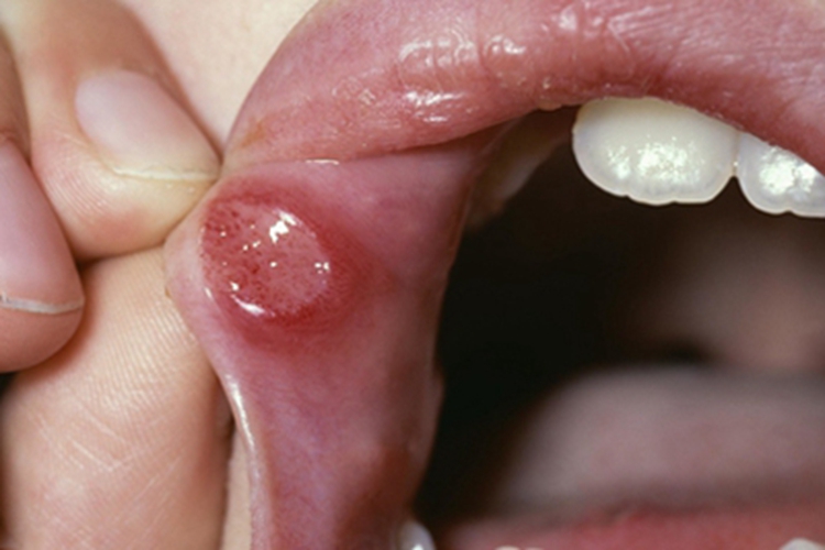 皮肤白喉上侧嘴唇溃疡图 皮肤白喉上侧嘴唇溃疡图