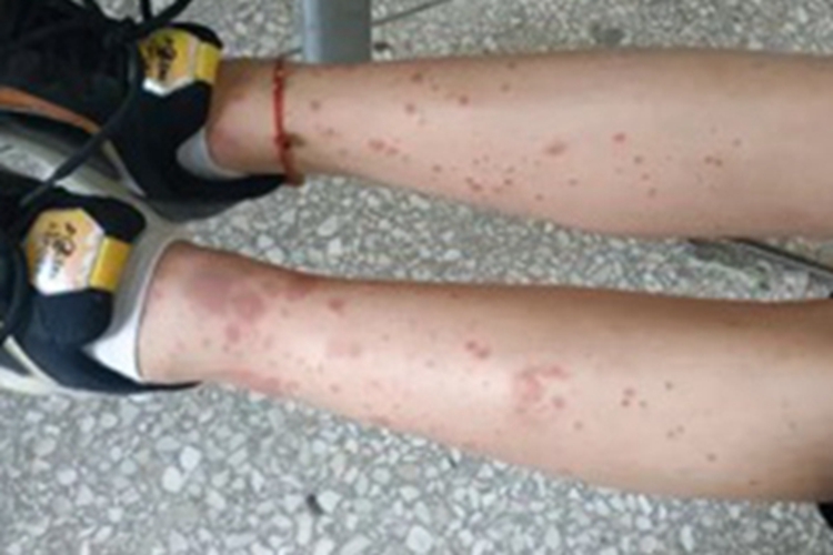 过敏性紫癜小腿有散在红斑图