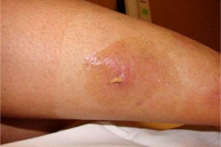 皮肤蝇蛆病小腿红肿图