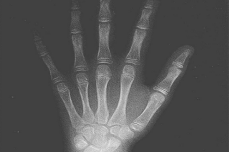 九岁女孩骨龄图