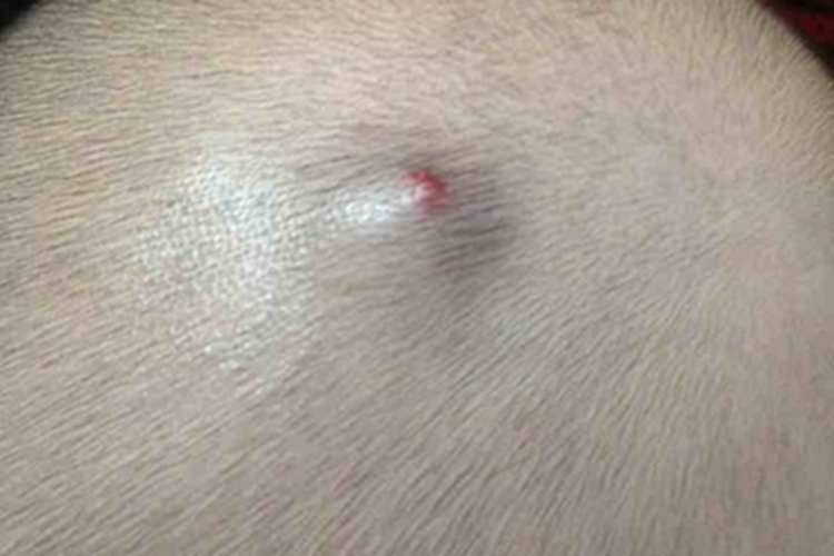 血管瘤头部大疙瘩图 血管瘤头部大疙瘩图