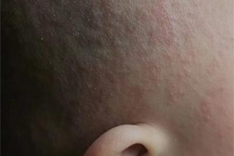 急性湿疹疙瘩图