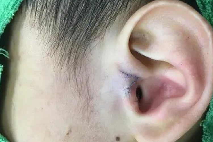 附耳切除后图 附耳切除后图