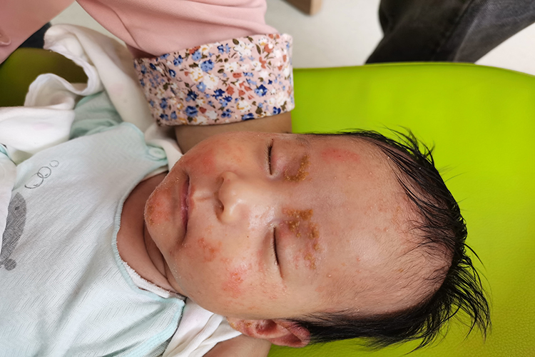 面颊部瘙痒性红斑图