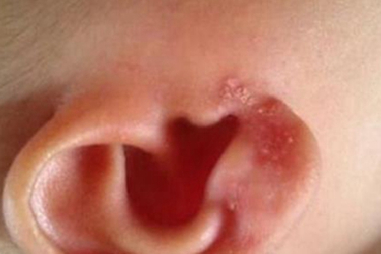 外耳湿疹耳朵红肿脱皮图
