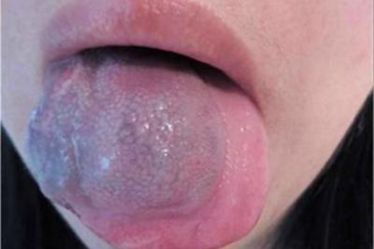 静脉畸形舌头肿图