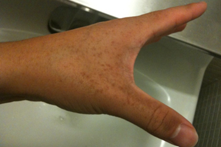 网状肢端色素沉着症状图 网状肢端色素沉着症状图