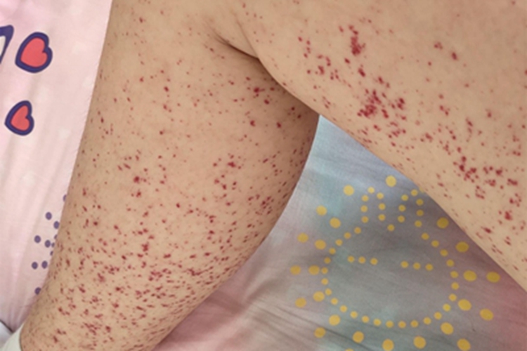 皮下出血小腿针尖血点图