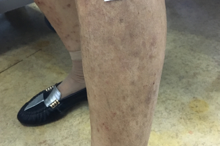 湿疹愈合色素沉着图