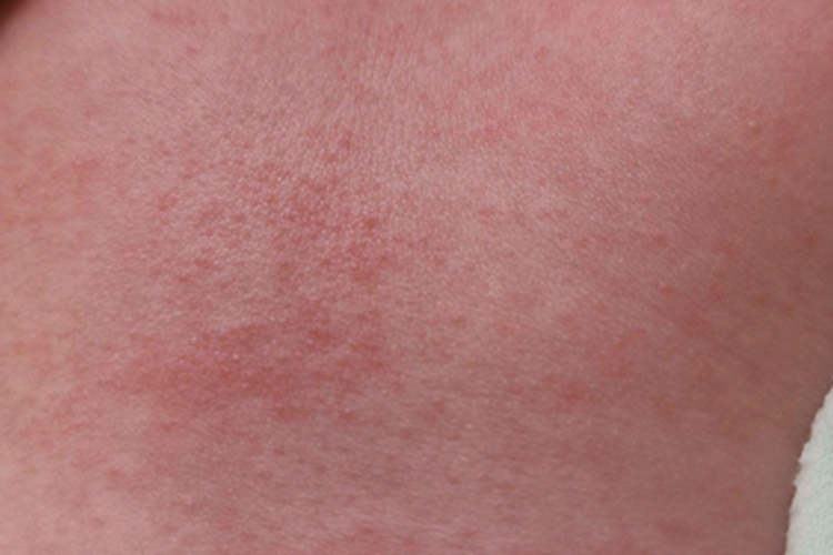 渗出型婴儿湿疹胸部症状图