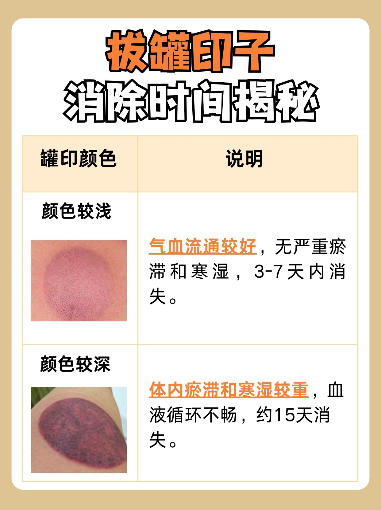 中医一文讲清：拔罐印子多久能消除？