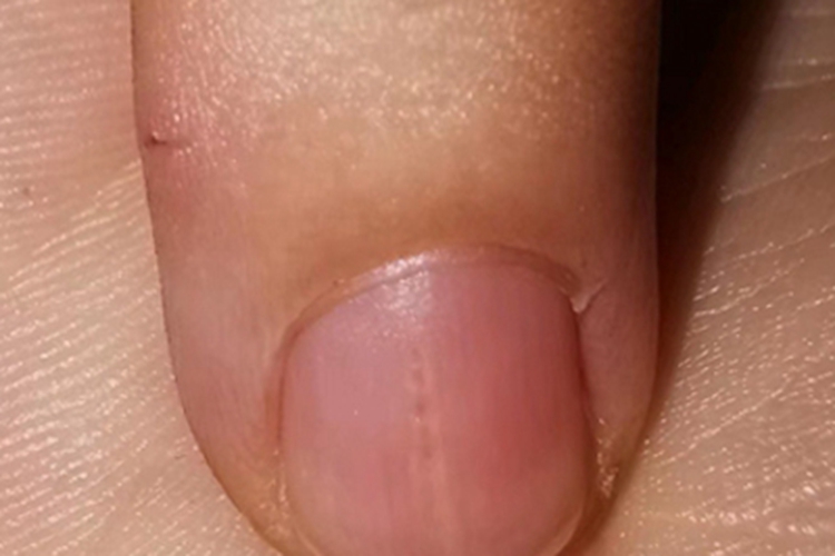 甲分离手指甲有长的竖纹图