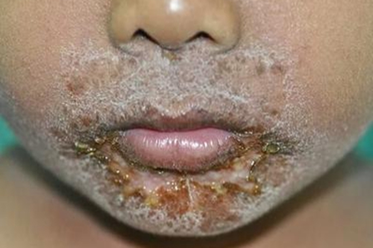 脓疱疮口周糜烂图