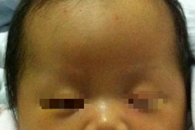 新生儿黄疸面部奶黄图