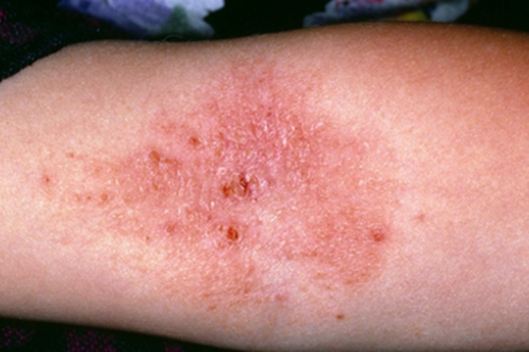 皮革皮炎肘窝处结痂图