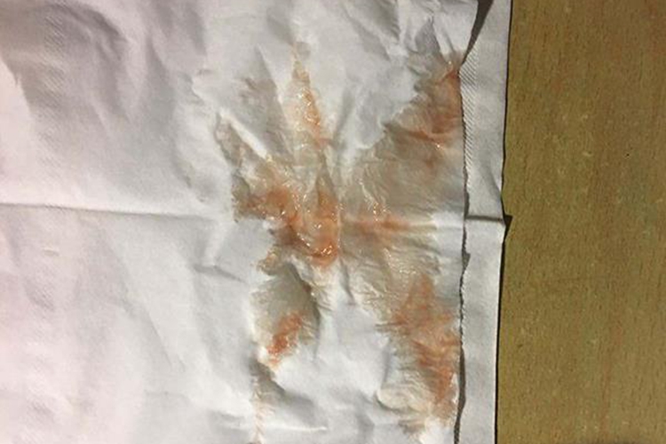 轻度血精图 轻度血精图