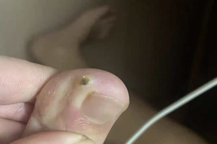 寻常疣脚趾黑痂图 寻常疣脚趾黑痂图