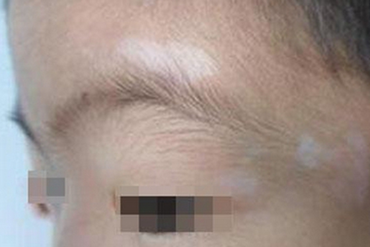 脱色素性痣面部有白斑图