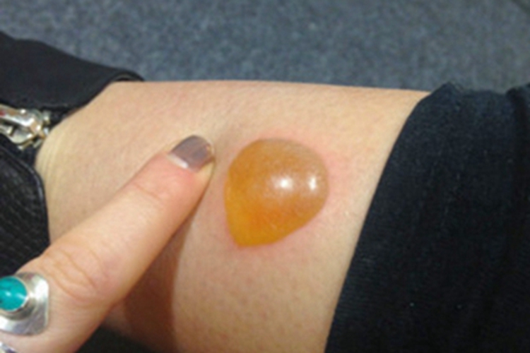 蜘蛛蜇伤水疱图