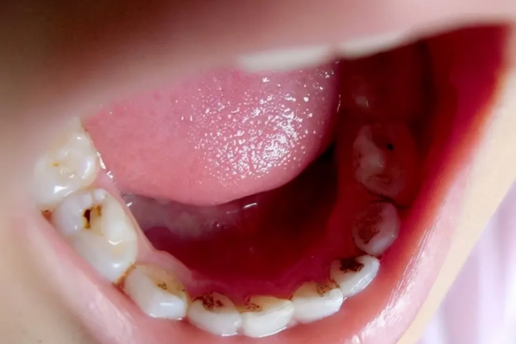 小孩不刷牙牙齿坏掉浅龋图