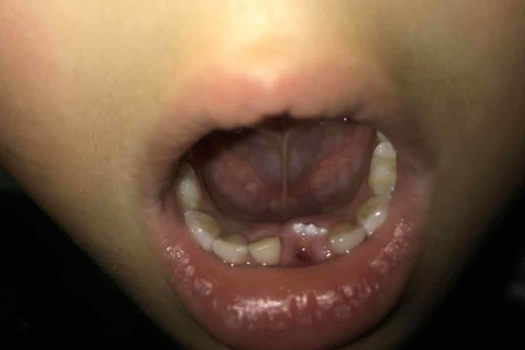 恒牙刚冒出来图 恒牙刚冒出来图