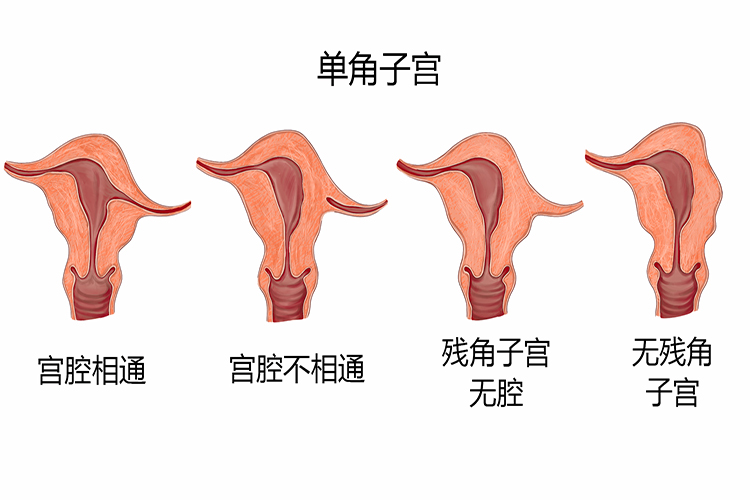 单角子宫图