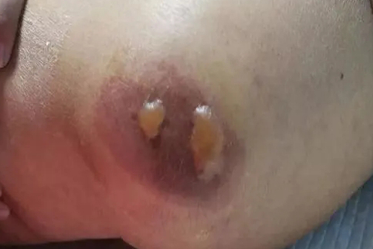 2期压疮水疱图 2期压疮水疱图