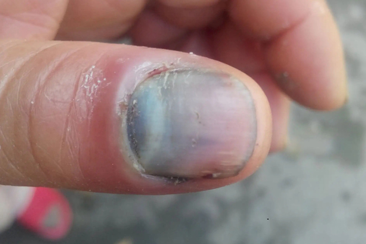 骨筋膜室综合征图 骨筋膜室综合征图