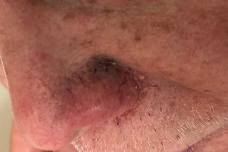 表浅型基底细胞瘤脱皮图