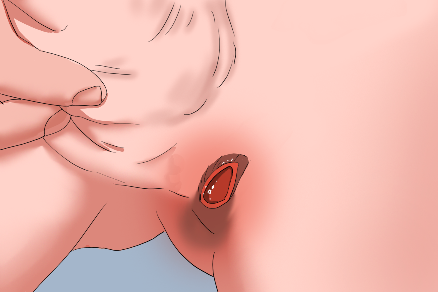 男性腹股沟肉芽肿症状图