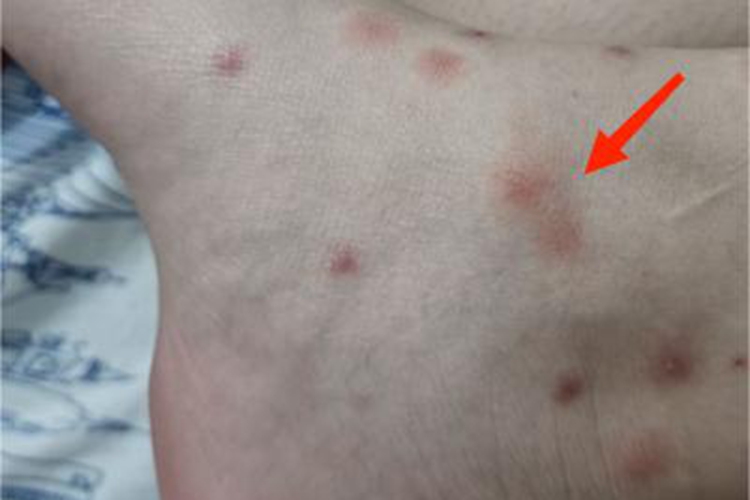 跳蚤叮咬皮肤颜色加深图 跳蚤叮咬皮肤颜色加深图